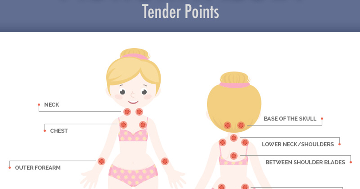 fibromyalgia-tender-points-what-and-where-are-the-tender-points-of